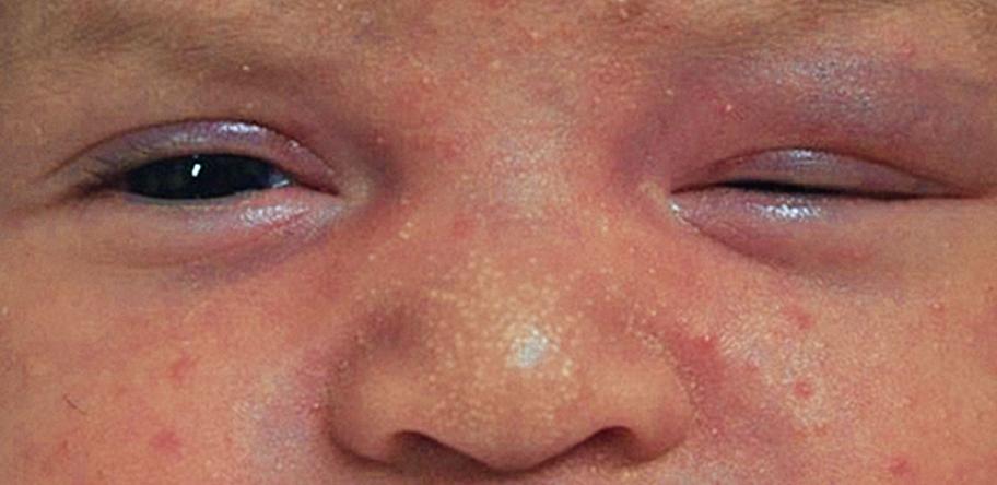 ptosis