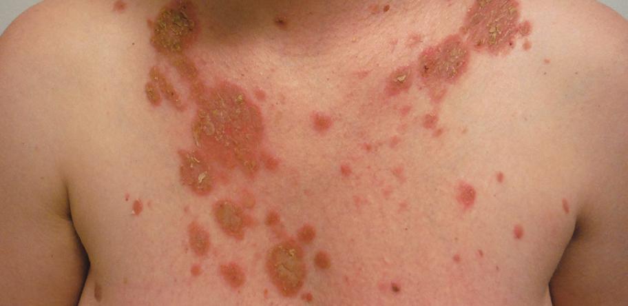 pemphigus foliaceus
