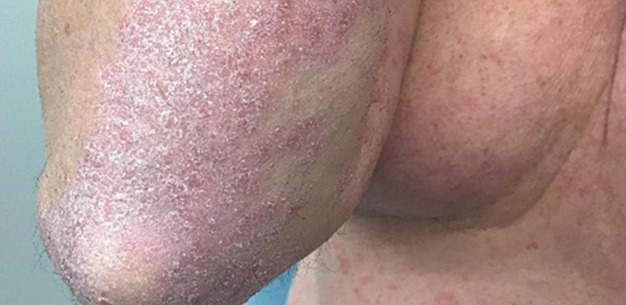 psoriasis
