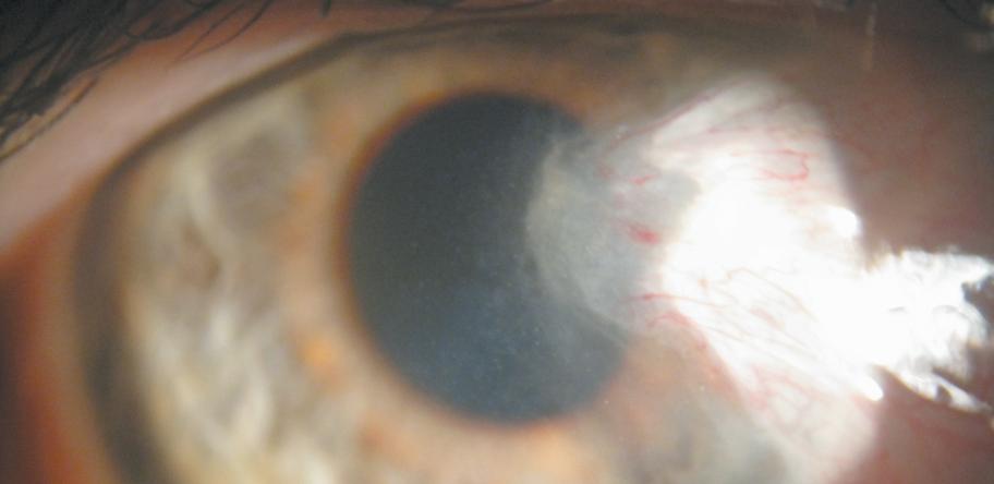 pterygium