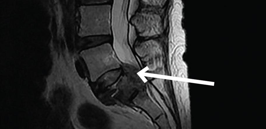 sacral tumour