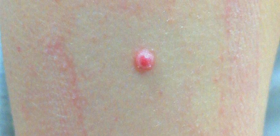 Quiz spitz nevus