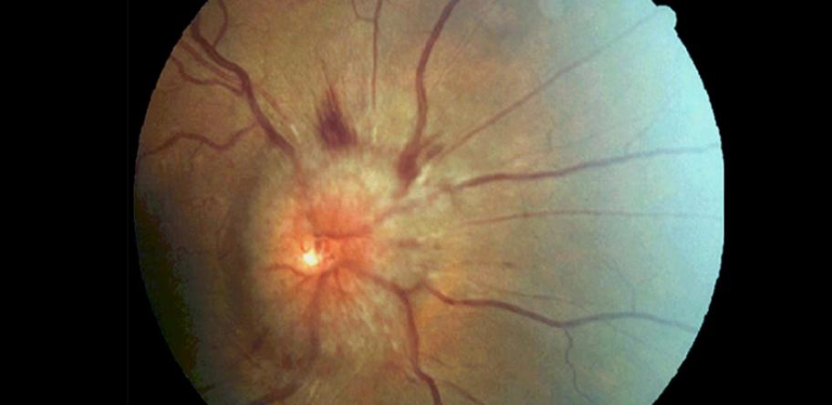 direct ophthalmoscopy