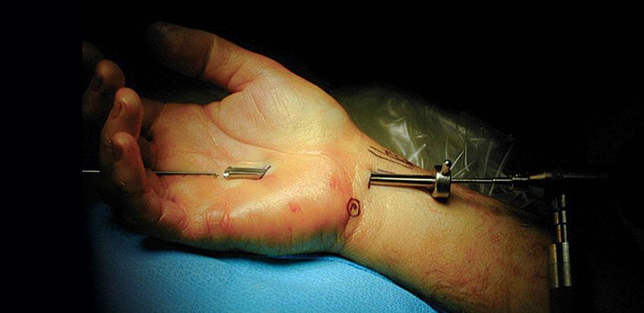 carpal tunnel