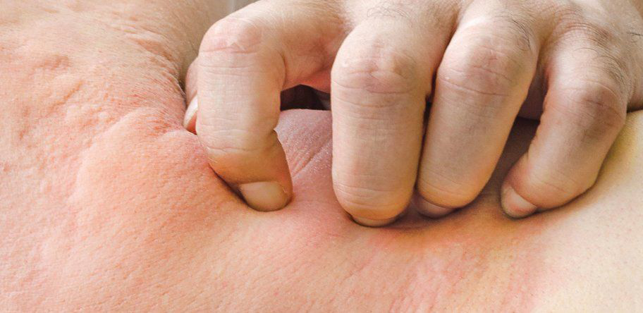 urticaria