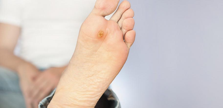 wart