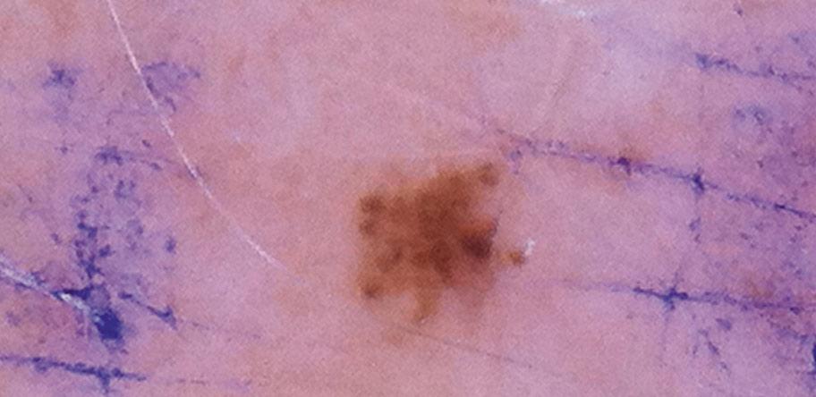 A minute pigmented skin lesion