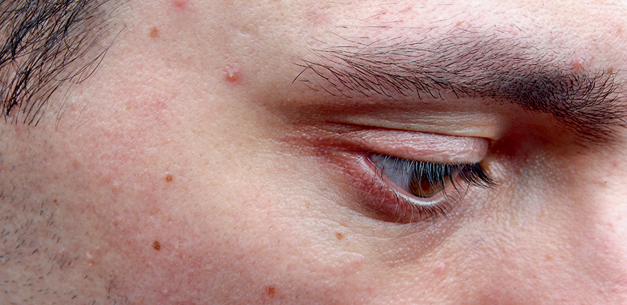 Acne