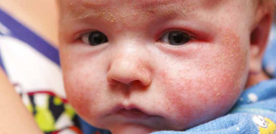 eczema