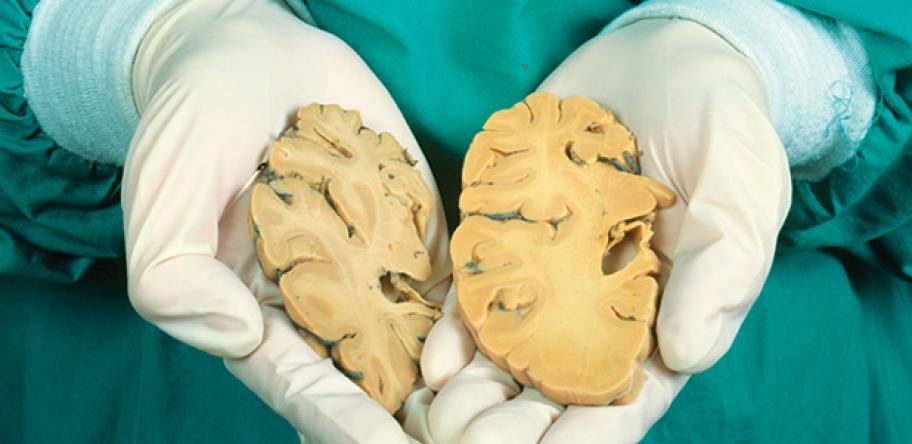 alzheimers