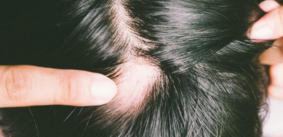 alopecia areata