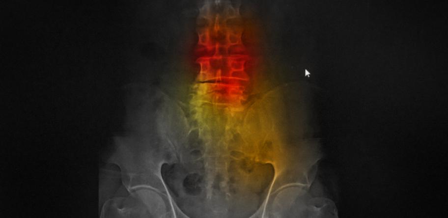 Ankylosing spondylitis