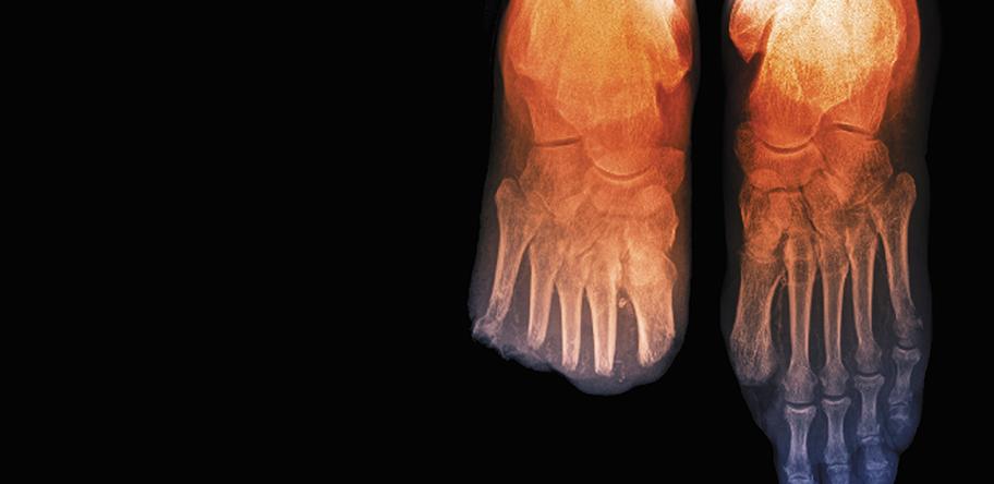 Toe_amputations_in_diabetes_X-ray