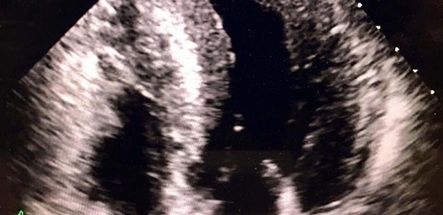 echocardiogram