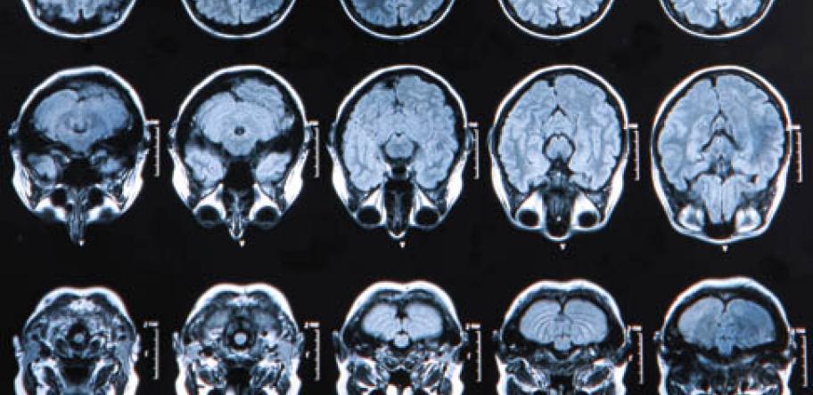 Brain MRI