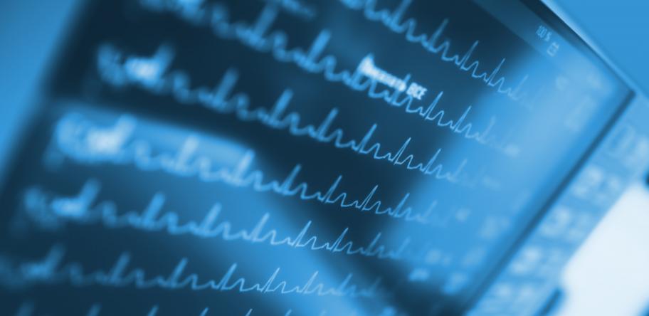 Cardiac catheter ablation for AF